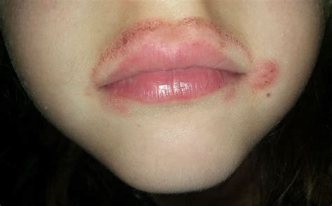 Skin Rash Around Lips | Lipstutorial.org