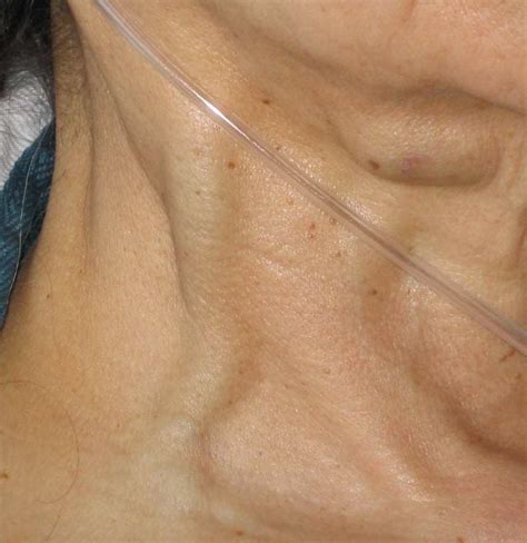 Jugular vein distention (JVD): Causes, risk factors, and diagnosis