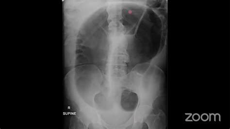 A structured approach, common cases and pitfalls to Abdominal and Pelvis X Rays - YouTube