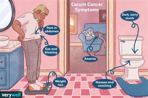 Cecum Cancer: Symptoms, Diagnosis, Treatment, and More