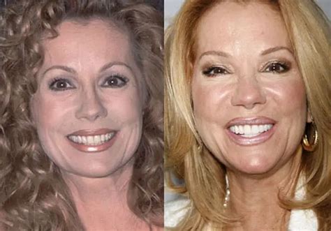 Kathie Lee Gifford Plastic Surgery Before and After Botox Injections ...