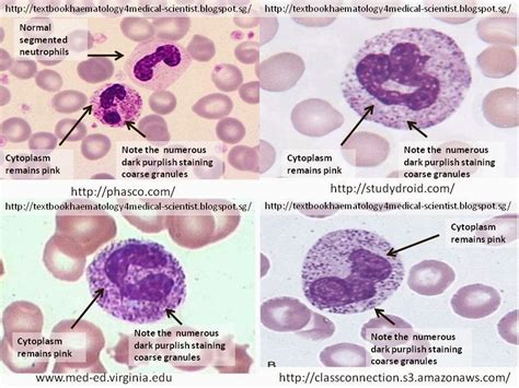 Haematology in a NutShell: Toxic Granulated Neutrophils