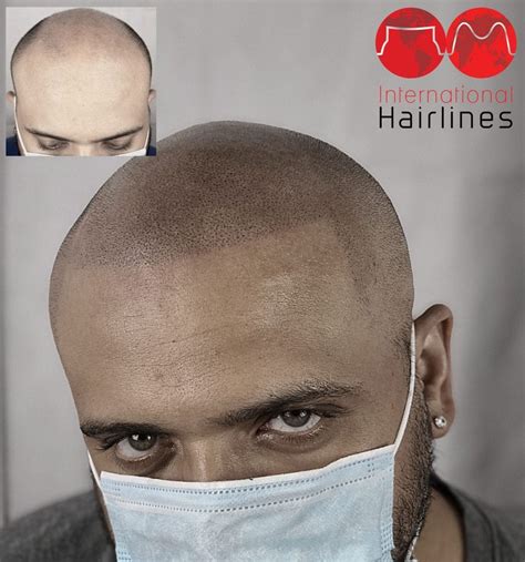 Scalp Micropigmentation Aftercare Guidelines - International Hairlines