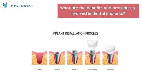 Various benefits and procedures of dental implants