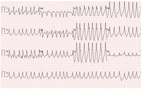 Wolff-Parkinson-White Syndrome: Electrocardiogram - JETem