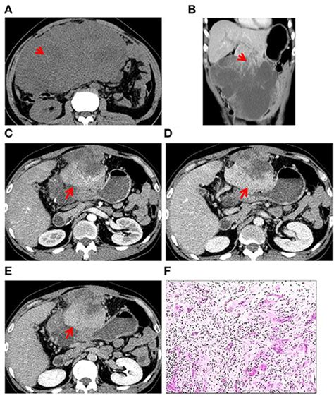 Frontiers | Case Report: Review of CT Findings and Histopathological Characteristics of Primary ...