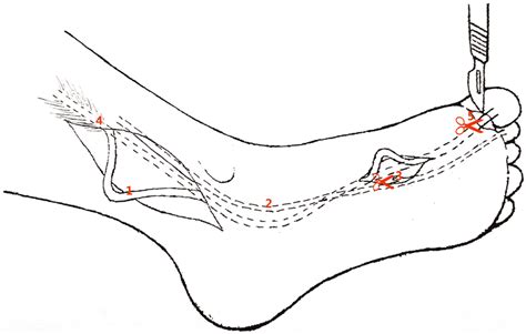 Minimally invasive technique (1). FHL tendon, (2). FDL tendon, (3 ...