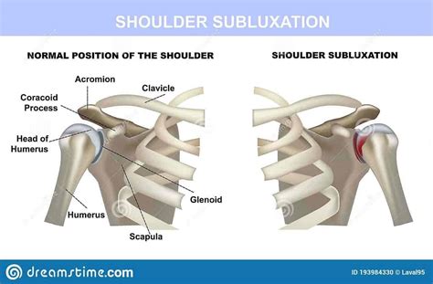 Remedies for Shoulder Pain - Exercises & More - Vital Wellness Centre