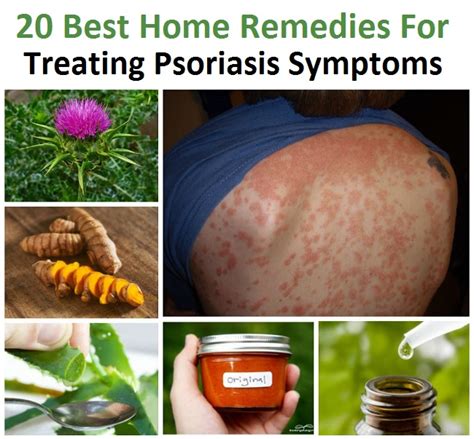 20 Best Home Remedies For Treating Psoriasis Symptoms