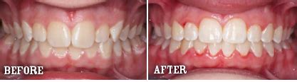 Magic of a Retainer: Before and After Photos to Prove It | New Health ...