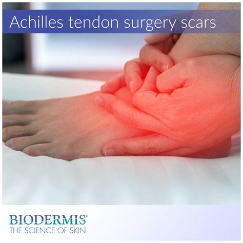 Achilles Tendon Surgery Scar Care | Biodermis.com