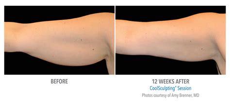 Non Surgical Arm Lifts, Armpit Fat, Fat Removal for Arms (2024)