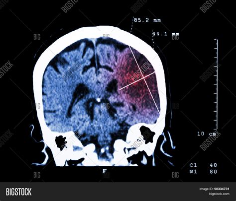 Cerebral Infarction Image & Photo (Free Trial) | Bigstock