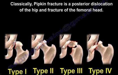 Classification and Types of Hip Dislocation — OrthopaedicPrinciples.com