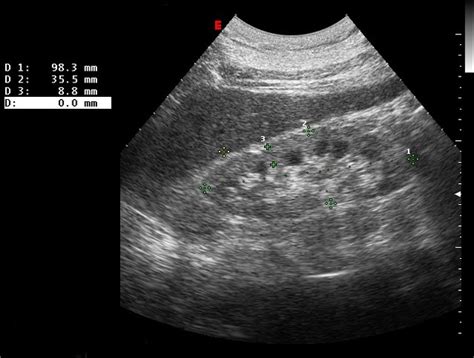 Damaged Kidney Ultrasound