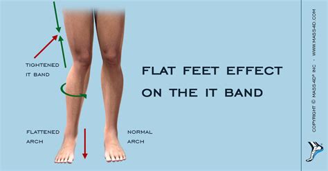 The Effect of Flat Feet on the IT Band - MASS4D® Foot Orthotics