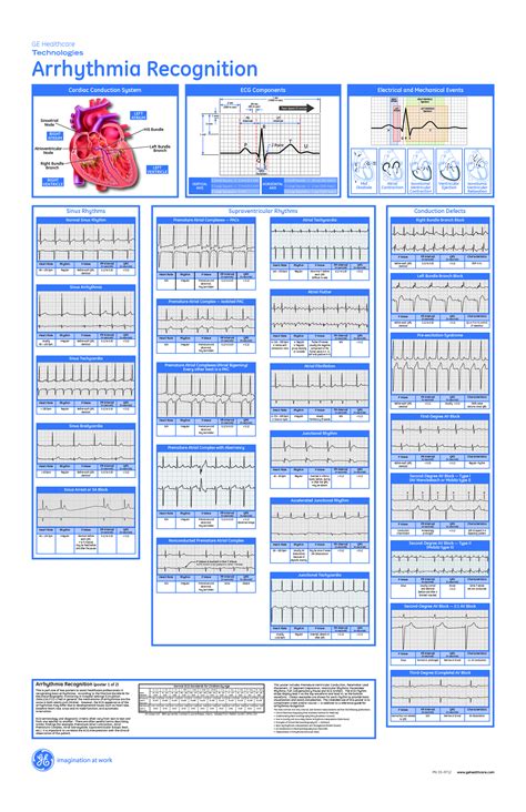 dysrhythmia interpretation | Critical care nursing, Nursing school ...