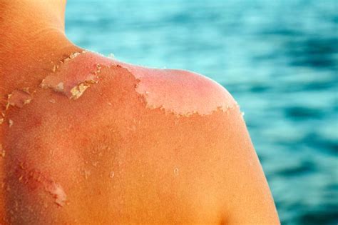 Sunburn Description, Causes, and Treatments