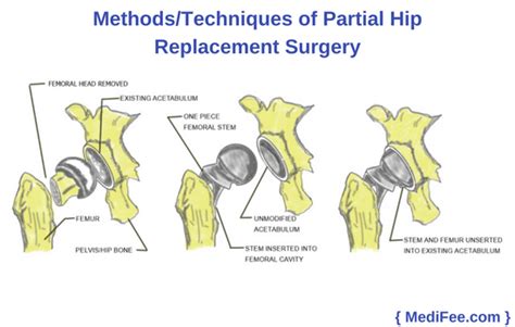 Partial Hip Replacement Surgery: Methods, Risks & Precautions