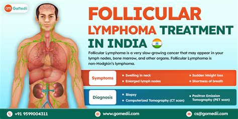 Follicular Lymphoma Symptoms Archives - GoMedii Blog