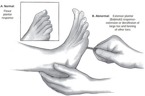 The plantar reflex - Babinski's sign