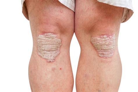 Schuppenflechte (Psoriasis) • Ursache, Symptome & Behandlung