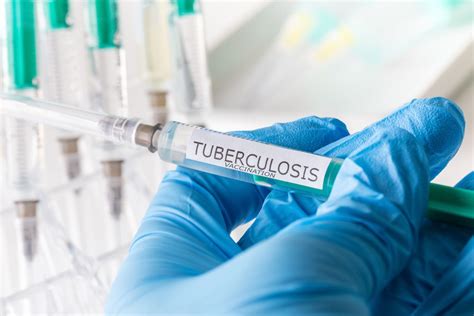 History and Modern Use of the Tuberculosis Vaccine