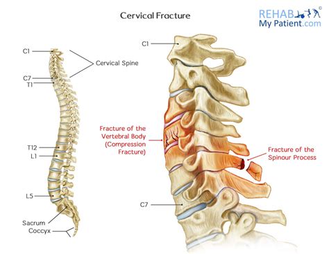 Cervical Fracture | Rehab My Patient