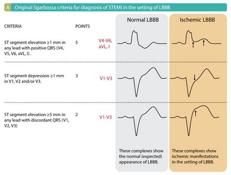 Left bundle branch block (LBBB) in acute myocardial infarction: the Sgarbossa criteria ...