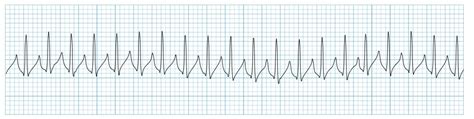 Svt Ecg Strip