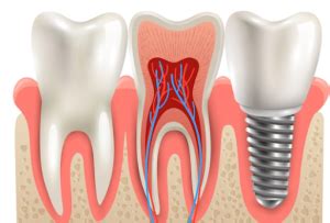 The Advantages and Risks Associated with Dental Implants