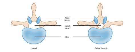 Lumbar Spinal Stenosis - OrthoInfo - AAOS