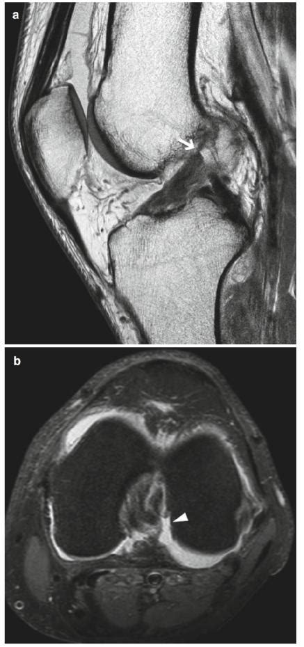 Confident Diagnosis - MRI ACL Torn - iNEWS