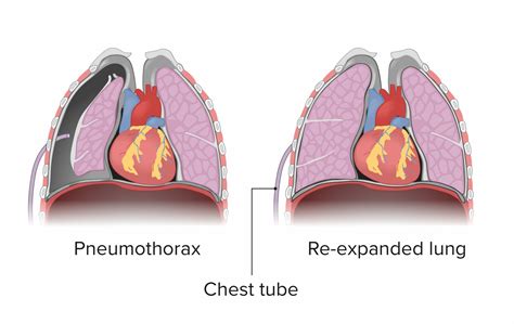 Chest Tube Pneumothorax