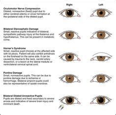 Risultati immagini per argyll robertson | Optometry, Optometry school ...