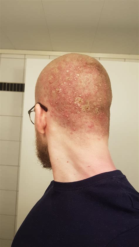 Check out my gross head : r/Folliculitis