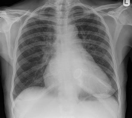 Mitral valve replacement | Radiology Reference Article | Radiopaedia.org