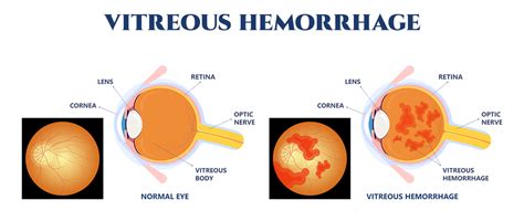 Vitreous Hemorrhage | South Carolina Retina Institute