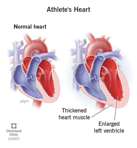 Athlete’s Heart: Causes, Symptoms & Treatment