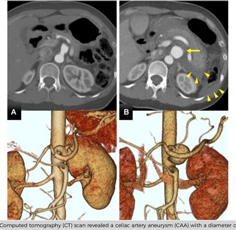 Figure 2 from Treatment of celiac artery rupture with a hybrid procedure involving aortic stent ...