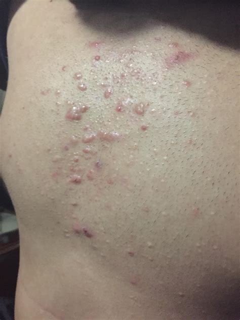 [Acne] My friend's chest is covered in cystic acne. Can you guys suggest anything so I can help ...