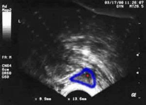 Antral Follicle Counts, Testing Ovarian Reserve Predicts IVF Response