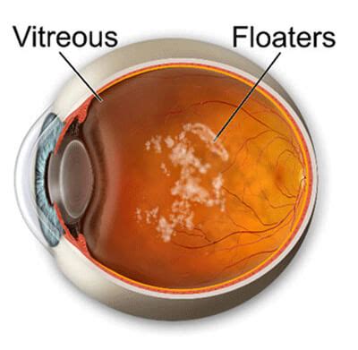 Posterior Vitreous Detachment Floaters