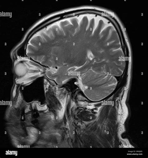 Healthy human brain, MRI scan Stock Photo - Alamy