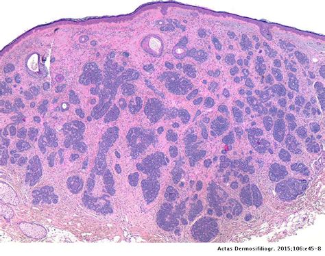 Dermoscopic Findings in Trichoblastoma | Actas Dermo-Sifiliográficas ...