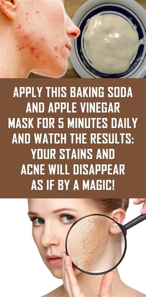 Apply This Baking Soda And Apple Vinegar Mask For 5 Minutes Daily And ...