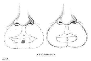 Karapandzic皮瓣技术。