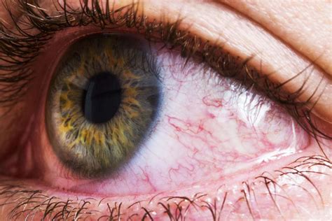 Can Bloodshot Eyes Be Serious? When to Seek Help