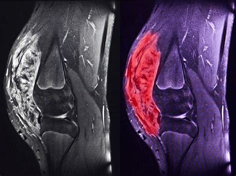 Sarcomas, tan complejos que son considerados dentro de las enfermedades raras