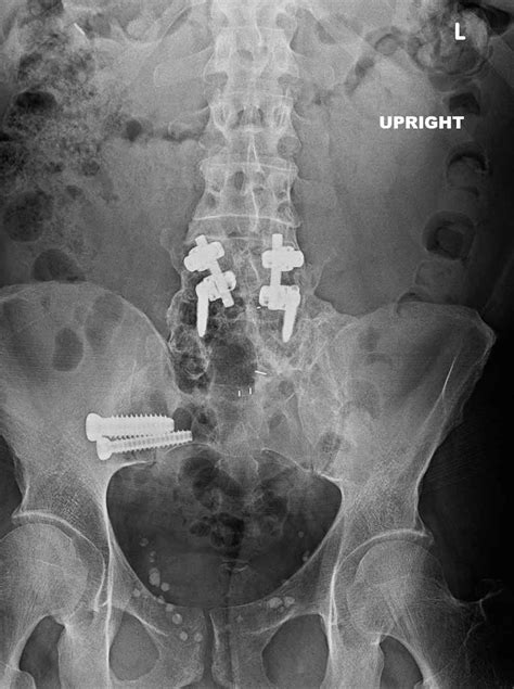 Si Joint Fusion Success Rate | Science Relief